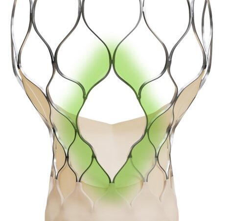 Medtronic Introduces Evolut™ FX+ in India — A Move Forward in TAVI Therapy for Aortic Stenosis